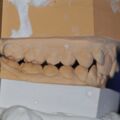Instrumentelle Okklusionsanalyse Ausgangsbefund