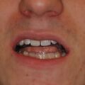 Adjustierter Aufbissbehelf