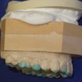 Diagnostisches Wax Up