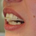 Adjustierter Aufbissbehelf