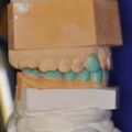 Instrumentelle Okklusionsanalyse, Diagnostisches Wax UP