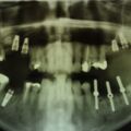 OPG 2006, Implantate