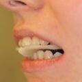 Adjustierter Aufbissbehelf