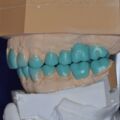 Instrumentelle Okklusionsanalyse Diagnostisches Wax UP