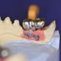 Interdentale Hygienefähigkeit