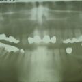 OPG 2003 vor Implantaten