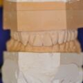 Instrumentelle Okklusionsanalyse, Bisslage in "Zentrischer Kondylenposition"