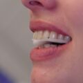 Adjustierter Aufbissbehelf