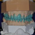 Instrumentelle Okklusionsanalyse Diagnostisches Wax UP