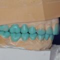 Instrumentelle Okklusionsanalyse Diagnostisches Wax UP