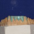 Diagnostisches Wax Up