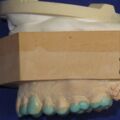 Diagnostisches Wax Up