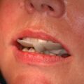 Adjustierter Aufbissbehelf
