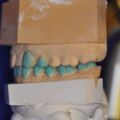 Instrumentelle Okklusionsanalyse, Diagnostisches Wax UP