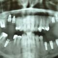 OPG 2006, Implantate