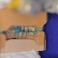 Instrumentelle Okklusionsanalyse, Diagnostisches wax up in Zentrischer Kondylenposition