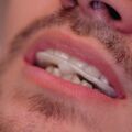 Adjustierter Aufbissbehelf