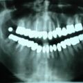 OPG 2007, Implantat