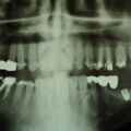 OPG 2004 Implantatinsertion